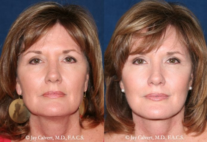 Dr. Jay Calvert, Beverly Hills Plastic Surgeon, comments on the facelift trend among Baby Boomers